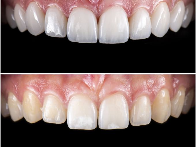 Veneers